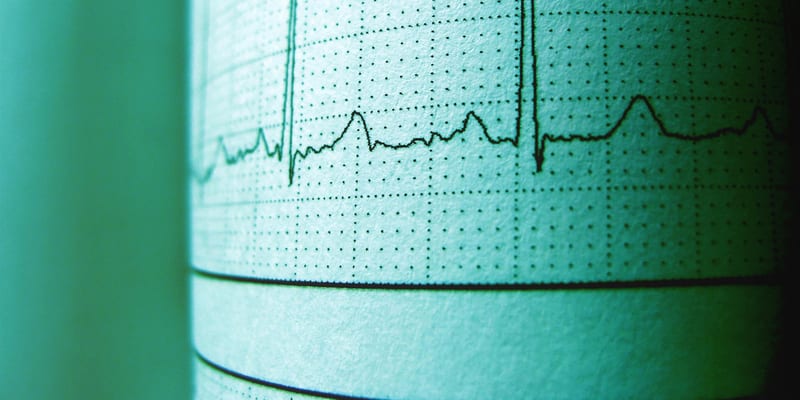 EKG signal visualization for cardiovascular disease prediction